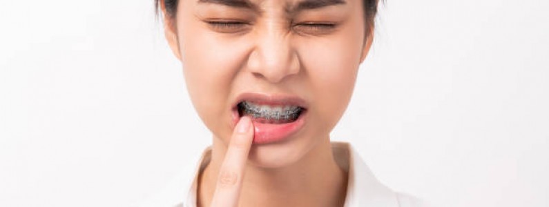 Top 5 Tips to Manage Pain and Discomfort After Getting Braces!