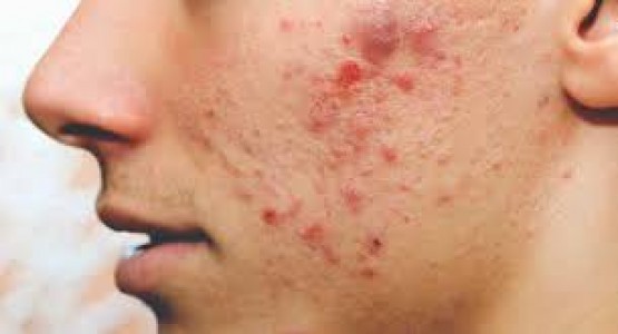 10 Tips Para Mawala ang Pimples: Epektibong Paraan para sa Malinis na Balat