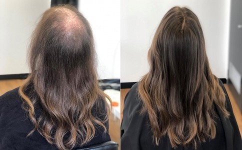 Hair Transplant Results That Look and Feel Natural