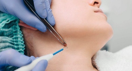Mole Removal In Dubai: How to Prepare for Treatment