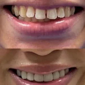 Dental Veneers in Lahore – Your Ultimate Guide to a Perfect Smile