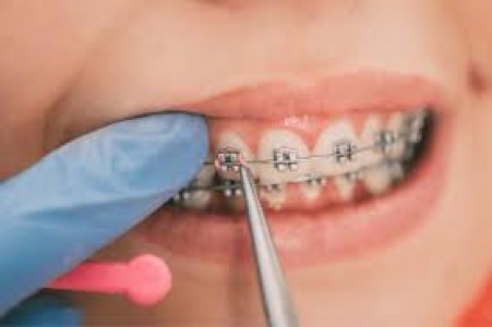 Do Orthodontists Offer Payment Plans for Treatment?