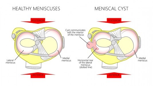 What You Need To Know About Meniscal Cyst?