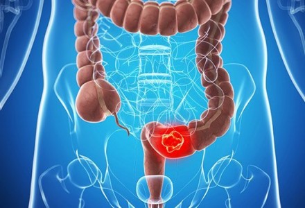 Colon Cancer Treatment in India: A New Era of Hope and Healing