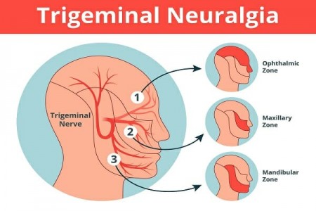 Top 5 Treatment Options for Trigeminal Neuralgia in 2025