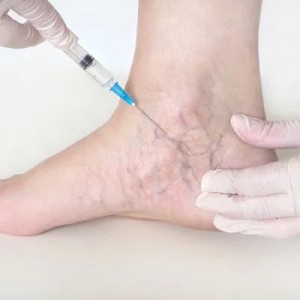 What to Expect During Spider Vein Treatment?