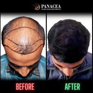 The Best Hair Transplant Doctor in Delhi Bringing Remarkable Changes