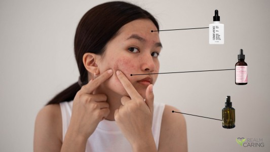 Weed and Acne: Does Weed Give You Acne or Help Your Skin?