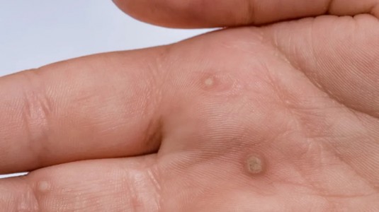 Top Treatments for Warts in Pakistan: What Works and What Doesn’t